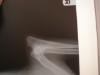 Right Elbow xray