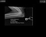 OFA elbow X-rays (right elbow)