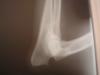 Left Elbow xray