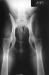 Ellen's hip X-rays...A Normal
